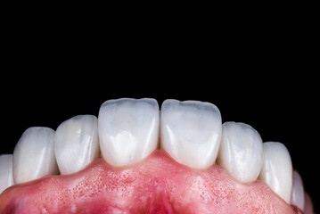 created new smile by crowns implants and veneers