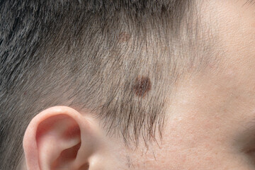 Brown big birthmark on the man's head. - obrazy, fototapety, plakaty