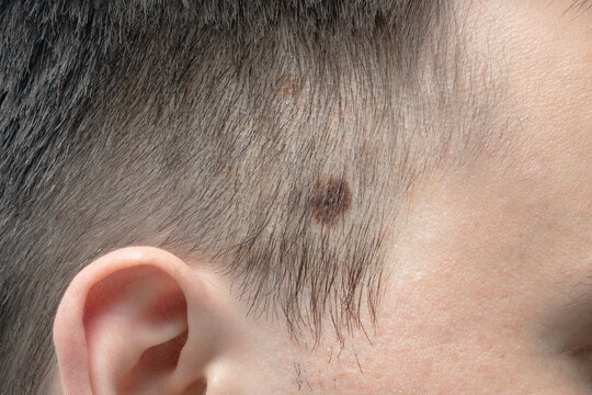 Brown big birthmark on the man's head.