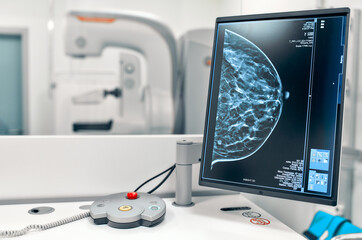 Mammogram snapshot of breasts of a female patient on the monitor with undergoing mammography test...