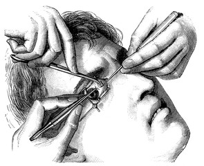 Strabismus surgery. Illustration of the 19th century. Germany. White background.