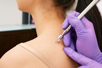 Close up dermatologist removing a mole on a woman's back using a laser knife. Painless removal of...