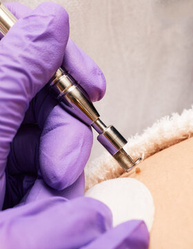Mole removal on human body with medical contactless laser, close-up
