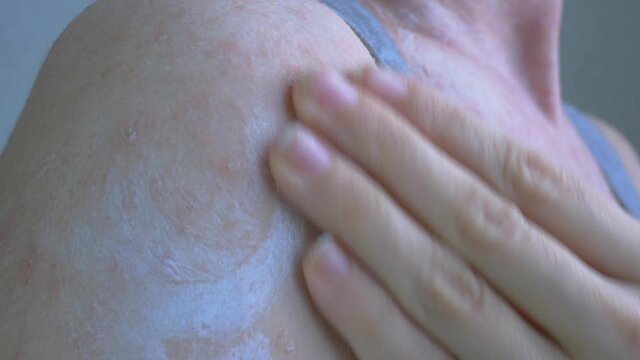 The womans body is covered with pale pink spots of pathological elements. Apply a white ointment with your hand to the soiled area of the skin and rub in. Close-up.