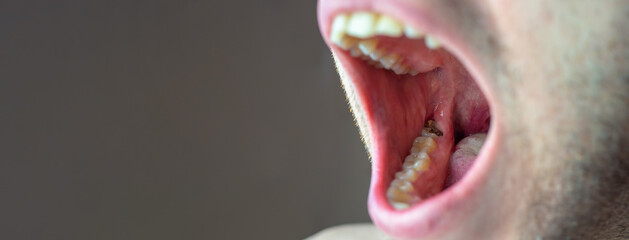 Rotten carious tooth close-up. Banner. Copy space with place for text