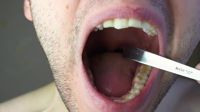 Rotten carious tooth close-up. Tooth before removal
