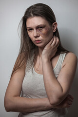 Domestic violence, abuse woman with bruise on face