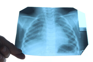 A snapshot of the lungs. Fluorography. Healthy lungs. Chest x-ray into the lumen on a white screen....