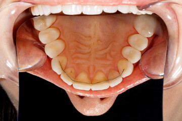 Dental of teeth after treatment. Photo of teeth close up. Teeth whitening image. Treatment plan for new smile. Making bleach veneers. Dental photography