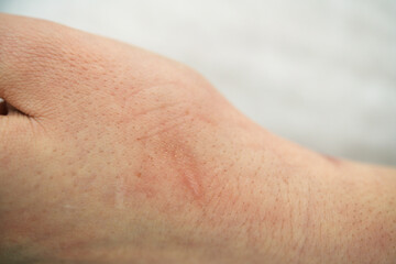 Traces on the arm from after laser therapy
