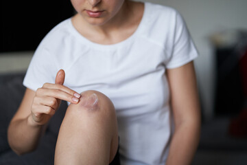 Close up of a person rubbing cream for healing injured knee joint. Bruise on the knee. Leg pain