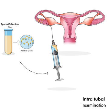 intra tubal form of artificial insemination for pregnancy vector illustration 