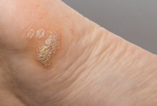 Plantar wart close up on the bottom of a female foot heel caused by the human papillomavirus, or HPV