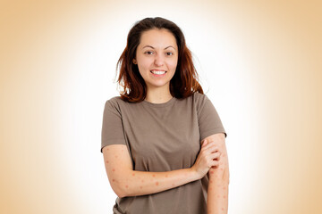 A young woman is nervously scratching her hands for rashes and redness. Beige background. The...