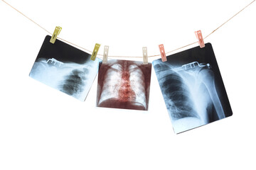 Photos of x-ray human shoulders and human lungs fixed with colorful clothespins on a rope isolated on white background.