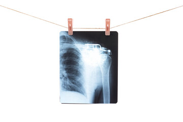 Photo of x-ray human shoulder fixed with colorful clothespins on a rope isolated on white background.