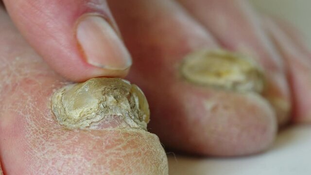 Closeup of a foot with damaged nails because of fungus. Elderly man legs.