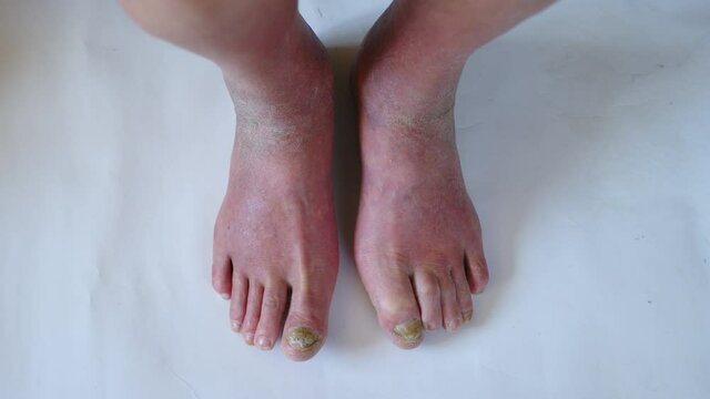 Closeup of a foot with damaged nails because of fungus. Elderly man legs.