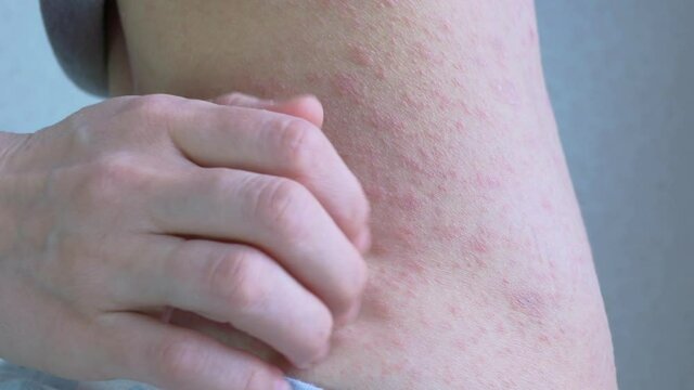 Close-up shot of the side of the abdominal cavity, the agalene area is completely covered with pathological elements. The spots are red and of different sizes. Viral diseases. Itching on the skin.