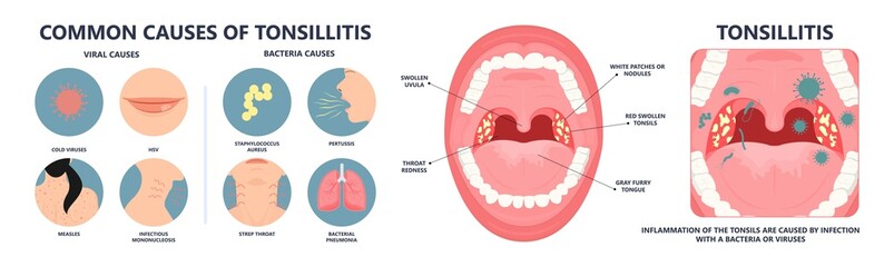 Tonsil Stones crypts viral virus gland strep throat sore enlarged lymph nodes neck pain swollen pus white mouth bacteria Herpes simplex HSV cold fever Epstein Barr fetid bad odor oral laser aureus