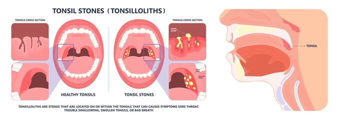Tonsil Stones crypts viral virus gland strep throat sore enlarged lymph nodes neck pain swollen pus white mouth bacteria Herpes simplex HSV cold fever Epstein Barr fetid bad odor oral laser aureus