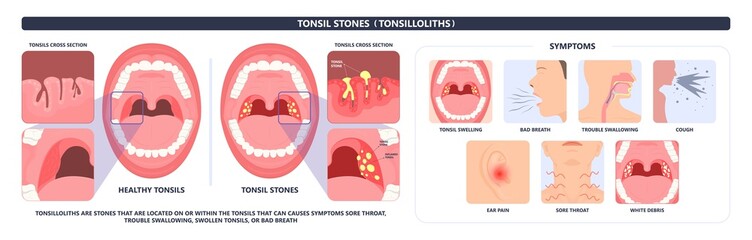 Tonsil Stones crypts viral virus gland strep throat sore enlarged lymph nodes neck pain swollen pus white mouth bacteria Herpes simplex HSV cold fever Epstein Barr fetid bad odor oral laser aureus