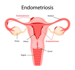 Diagram of endometriosis. Diseases of the female reproductive system. Vector illustration in a flat cartoon style.