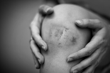 Selective focus of bruises and abrasions on the woman’s knee. Black and white tone. Accident and...