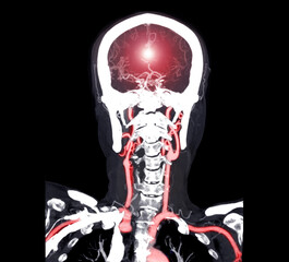 colorful of CT angiography of the brain or CTA brain  Coronal view . Clipping path.