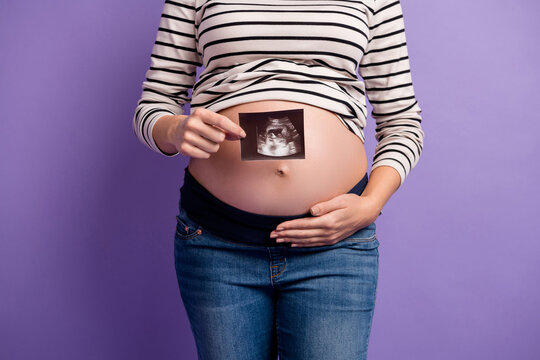 Cropped Photo Of Pregnant Lady Showing X-ray Icon Hand Abdomen Wear Striped Shirt Isolated Purple Color Background