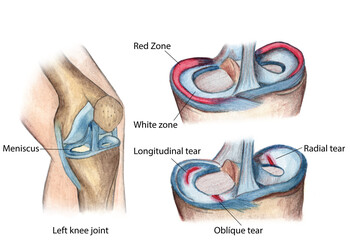 anatomy of the human knee meniscus tears - obrazy, fototapety, plakaty