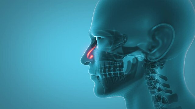 Development of nasal sinus inflammation. 3d animation of human head with sinusitis.