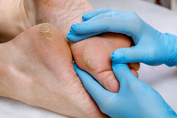 A pedicure doctor examines a patient's feet with problematic heels with cracks and dry skin. Foot...
