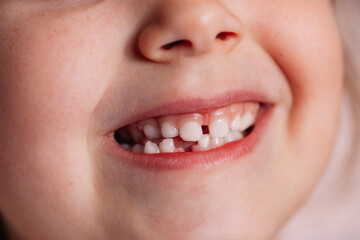 close-up the smiling mouth of a five-or six-year-old child with a hole in the gum on the lower row of teeth from a fallen baby tooth, pride in growing up.