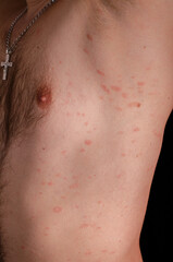 Pityriasis rosea is a type of skin rash