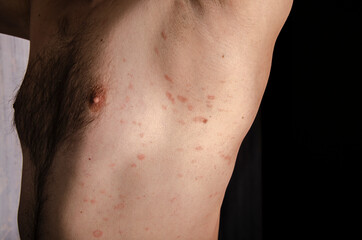 Pityriasis rosea is a type of skin rash