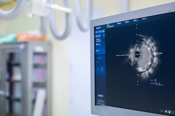 Intravascular ultrasound imaging (IVUS) at cardiac catheterization laboratory room.	