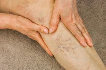 Hands of an elderly woman show on varicose veins, sick female legs