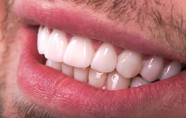 Obraz premium Perfect Close Up White beautiful Veneers Teeth bleaching crowns whitening young lady smiling, Male beard natural man smile. Dental zircon implants restoration surgery. Fashion concept