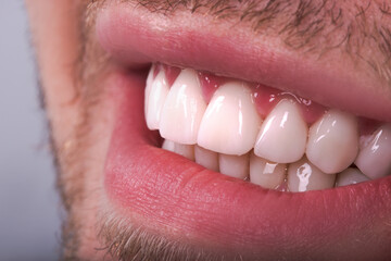 Obraz premium Perfect Close Up White beautiful Veneers Teeth bleaching crowns whitening young lady smiling, Male beard natural man smile. Dental zircon implants restoration surgery. Fashion concept
