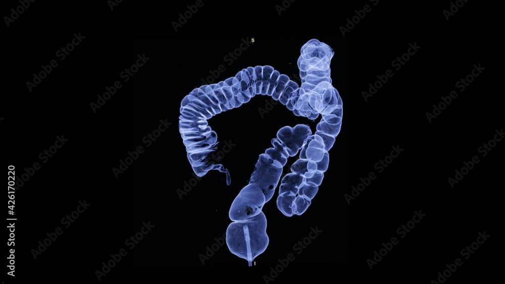 Poster ct colonography 3d rendering movie showing intra colon for screening colorectal cancer. check up scr