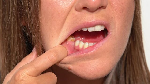 Young woman showing her mouth without tooth on lower jaw. Missing tooth or no tooth. Waiting an implant after tooth extraction