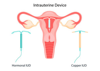 The method of IUD-contraception. Control and protection of pregnancy. Intrauterine device in the uterus. vector illustration in a flat style.