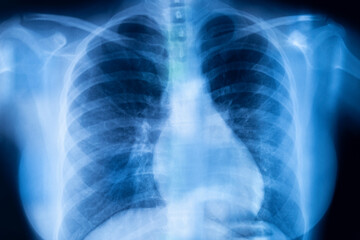 Lungs ribs xray scan - obrazy, fototapety, plakaty