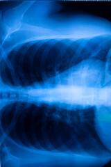 Lungs ribs xray scan