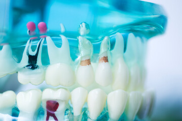 Tooth decay dental model
