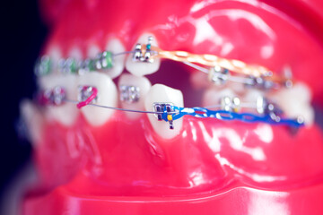Dental teeth aligners brackets