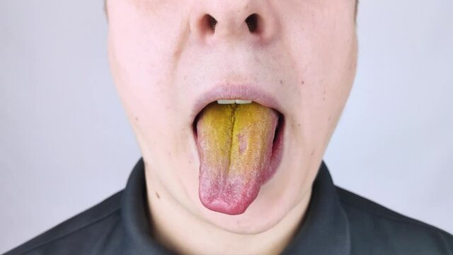 The man has a yellow tongue. Painful yellow coating on the mucous membrane of the tongue. Diseases of the gastrointestinal tract, liver and gallbladder. The consequences of taking antibiotics.