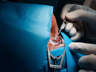 basra, Iraq - april 8, 2021:  surgeon putting contact lets on the cornea post PRK operation
