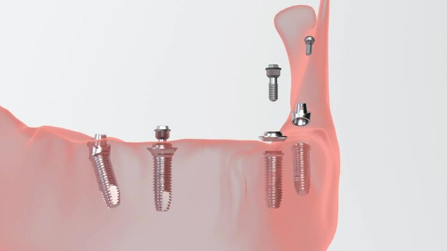 All on 4 system supported by implants, screw fixation. Medically accurate 3D illustration of dental Close Details